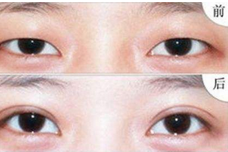 多次双眼皮手术会导致眼皮松弛吗