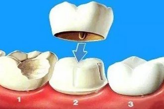 什么是牙冠修复