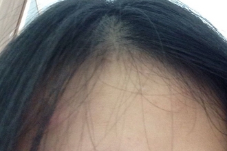 40岁女人头发稀疏怎么办