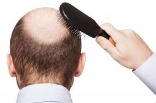 秃顶做头发种植手术大概需要多少钱