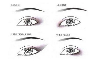 杭州近视眼能做双眼皮手术吗
