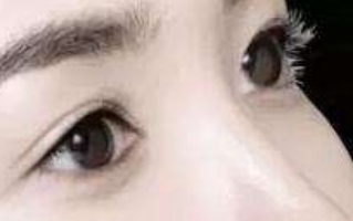 什么是韩式双眼皮